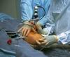 В Италии проведена операция по полной пересадке коленного сустава
