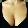 Отменен запрет на применение силиконовых имплантатов груди
