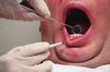 Возбудители болезней пародонта запускают процесс формирования зубного налета